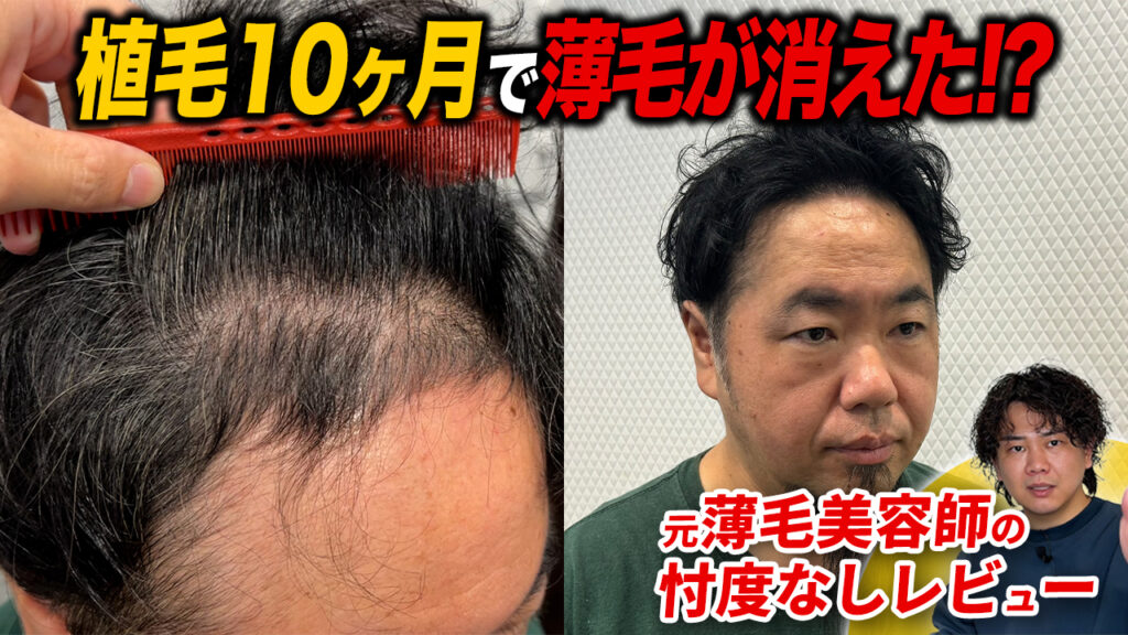 【植毛10ヶ月】髪は成長してる？まだ薄いところがある？薬事情も紹介