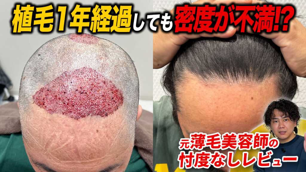 【植毛1年経過】少し密度が…40代植毛経験者の感想と現在の状態
