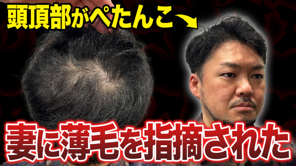 妻に言われ…38歳が薄い頭頂部を卒業するために植毛手術へ！現在の状態