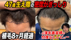 【植毛8ヶ月】生え際ラインが変化…！現在の状態とよくある質問