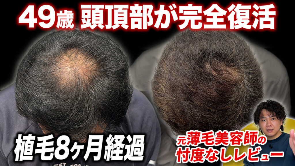 【植毛8ヶ月】本当に薄毛だった…？術後8ヶ月の頭皮の状態！ヘアセット後の状態も