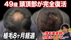 【植毛8ヶ月】本当に薄毛だった…？術後8ヶ月の頭皮の状態！ヘアセット後の状態も