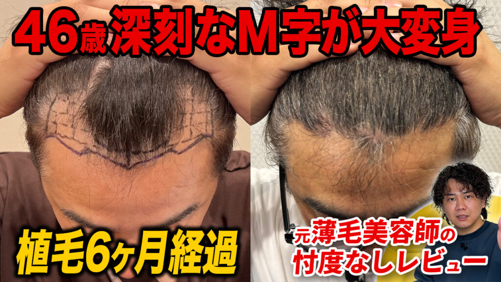【植毛6ヶ月】M字部分が全然違う？増毛スプレーなしでヘアセット