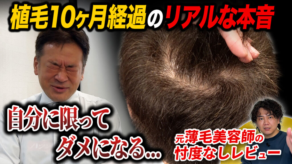 【植毛10ヶ月】50代が2,800グラフト移植した頭頂部の状態！お酒を飲むとき薬はどうしてる？