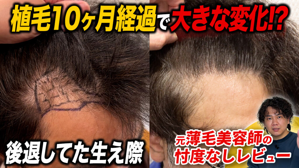【植毛10ヶ月】タバコは吸ってる？趣味は？植毛経験者の私生活とは