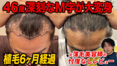 【植毛6ヶ月】M字部分が全然違う？増毛スプレーなしでヘアセット