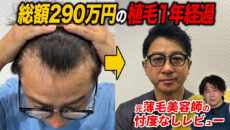 【植毛1年経過】M字ハゲは消えた？植毛のリアルな完成形を徹底レビュー