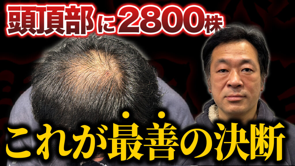【49歳が植毛】約30年のAGA治療を経て植毛手術へ！現在の状態