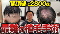 【植毛手術密着】頭頂部へ2,800グラフト移植！約9時間の手術の様子