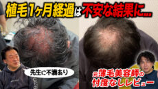 【植毛1ヶ月】頭頂部への植毛の成果は？ショックロスは？リアルな頭皮の状態