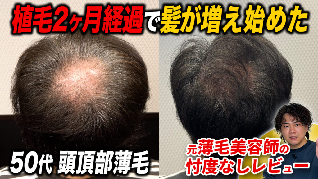 【植毛2ヶ月】ショックロスはきている？塗りミノを始めた？現在の状態