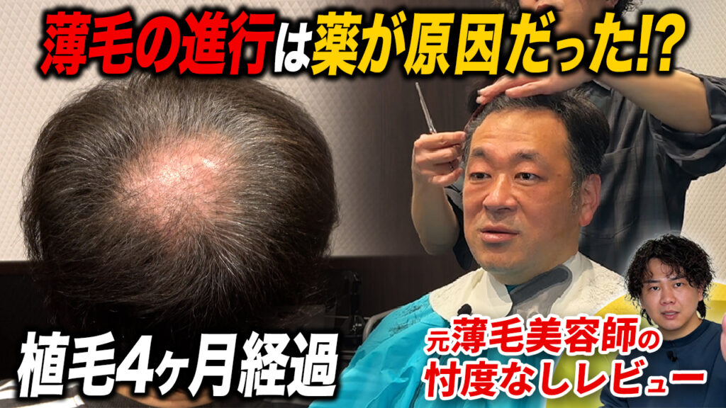 【植毛4ヶ月】2,800グラフト植毛した頭頂部が変化！頭皮の状態は？