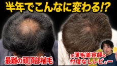 【植毛6ヶ月】増毛スプレー必要なし！変化した頭頂部の状態を正直レビュー