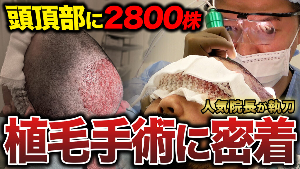 【植毛手術密着】30代男性が2,800グラフト移植！1日の流れ