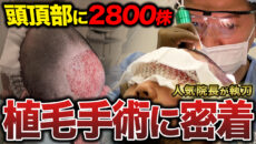 【植毛手術密着】30代男性が2,800グラフト移植！1日の流れ