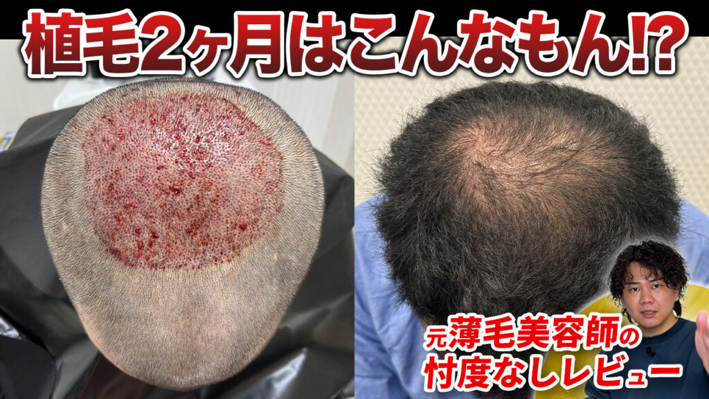 【植毛2ヶ月】30代男性2,800グラフト植毛の現在！まだ薄毛が目立つ？