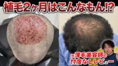 【植毛2ヶ月】30代男性2,800グラフト植毛の現在！まだ薄毛が目立つ？