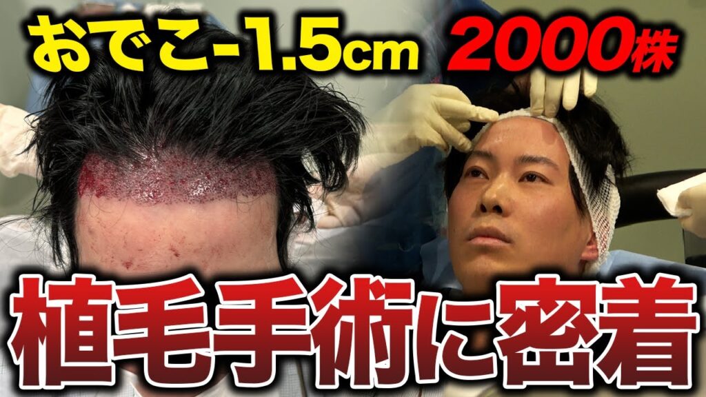 【植毛手術密着】35歳男性の挑戦！2,000グラフトでおでこはどこまで狭くなる？