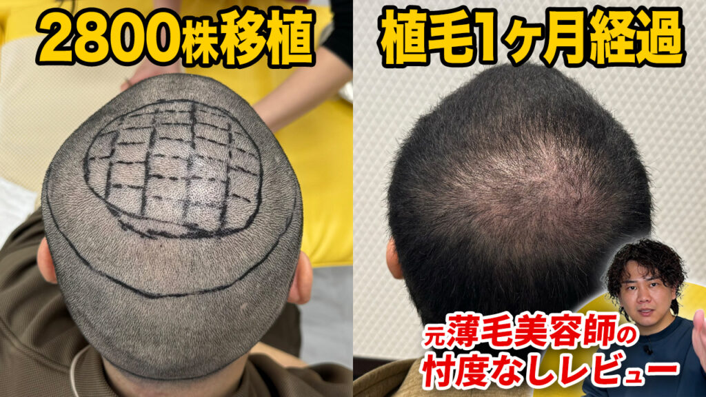 【植毛1ヶ月】坊主にして植毛手術した30代男性の現在は？頭皮の状態