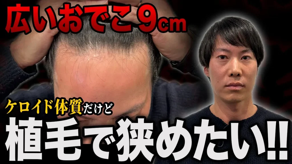 おでこが広い…ケロイド体質で植毛手術に挑む35歳男性の現在の状態
