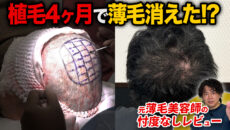 【植毛4ヶ月】髪が一気に伸びた！？30代植毛経験者の現在の状態