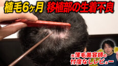 【植毛6ヶ月】生着していない！？現在の状態や半年検診の結果