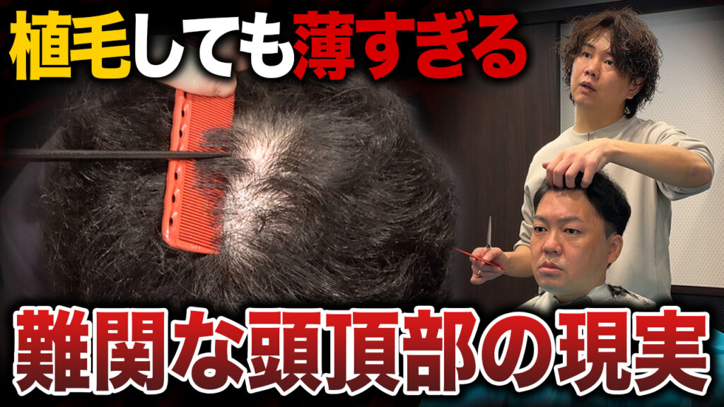 【植毛8ヶ月】前回より薄くなった？2,800グラフト移植後の現在の状態