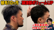 【植毛10ヶ月】調子が悪かったところはどうなった？30代男性の植毛後の現在の状態