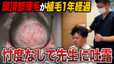 3月8本目【植毛1年経過】頭頂部への2,800グラフト移植の結果は？完成形を披露！