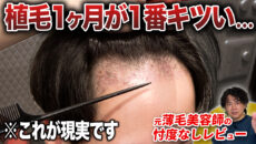 【植毛2ヶ月】ショックロスは来た？おでこを狭くした30代男性の現在の状態