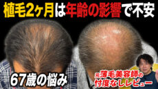 【植毛2ヶ月】ショックロスがきた！？2,500グラフト移植した60代男性の状態