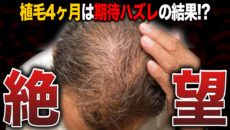 【植毛4ヶ月】期待外れ？2,500グラフト移植した60代男性の本音