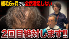 【植毛6ヶ月】今度は前の部分が気になってきた…？頭頂部に2,500グラフト移植した現在の状態