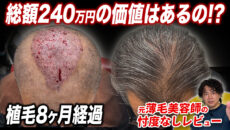 【植毛8ヶ月】植毛前と比べるとどう？頭頂部に2,500グラフト移植した60代男性の現在
