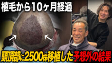 【植毛10ヶ月】移植していない箇所が気になってきた！2,500グラフト移植の10ヶ月後の状態