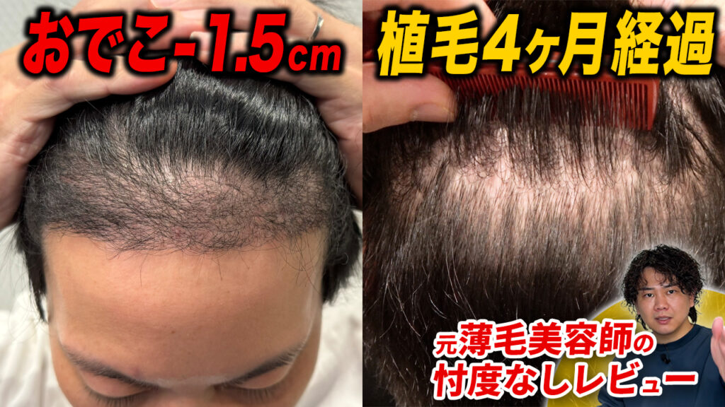 【植毛4ヶ月】ショックロスがきた！？植毛手術後の暗黒期の様子と増毛スプレーの使い方