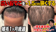 【植毛1ヶ月】ショックロスが来ていない？2,000グラフト移植した現在の状態