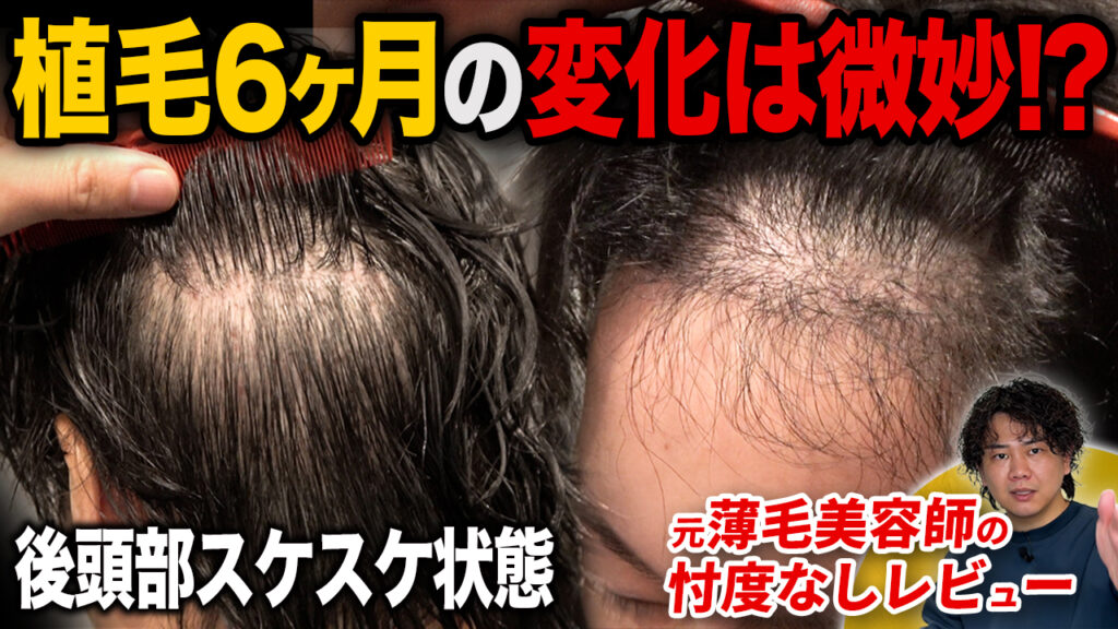 【植毛6ヶ月】植毛した毛が伸びてきた？2,000グラフト移植後の現在の状態
