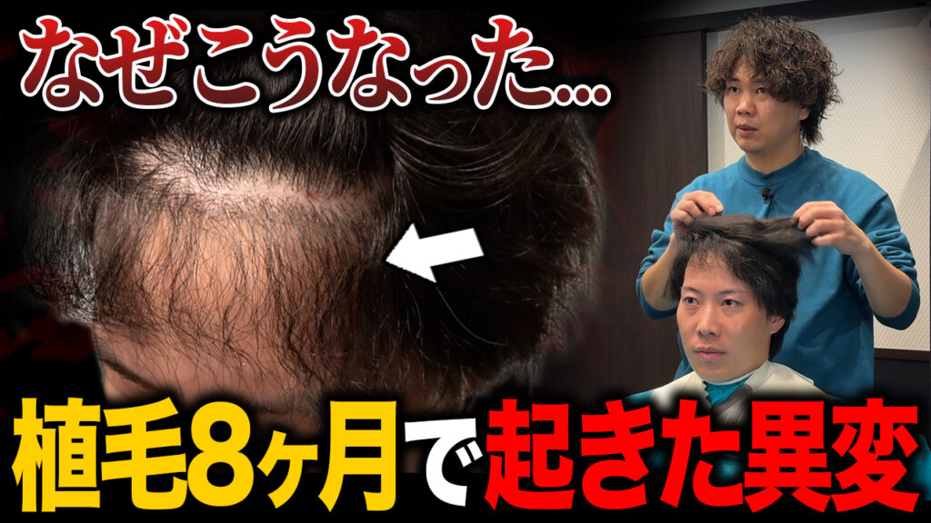 【植毛8ヶ月】植毛の成果は？2,000グラフトでおでこを狭くした現在の状態