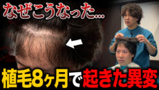 【植毛8ヶ月】植毛の成果は？2,000グラフトでおでこを狭くした現在の状態