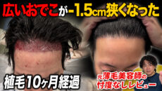 【植毛10ヶ月】パーマをかけたらどうなる？植毛後のリアルなボリューム感