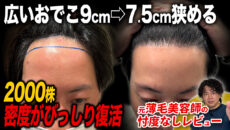 【植毛1年経過】おでこは狭くなった？2,000グラフト移植した30代男性の完成形