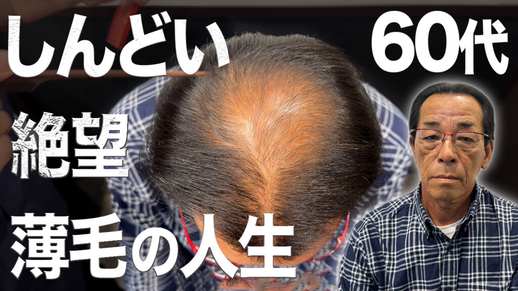 67歳で植毛手術を決断！頭頂部の状態やAGA治療歴は？