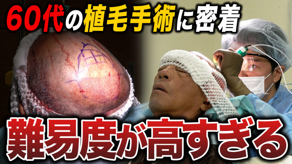 【植毛手術密着】60代が坊主にして臨む植毛手術の様子