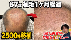 【植毛1ヶ月】60代で坊主にして2,500グラフト移植した現在の状態