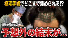 【植毛手術密着】ギリギリまで悩んだ…30代男性の植毛手術の1日を紹介！