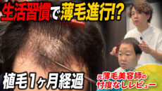【植毛1ヶ月】ミノタブを始めた？ショックロスは来た？術後1ヶ月の髪の状態