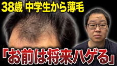 中学生から薄毛に悩んでいるアラフォー男性が植毛手術を決意！手術前の状態