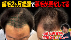 【植毛2ヶ月】植毛前より薄い…？暗黒期の30代男性の現在の状態