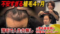 【植毛4ヶ月】薄毛に悩んでいるときは何が嫌だった？本音と現在の状態